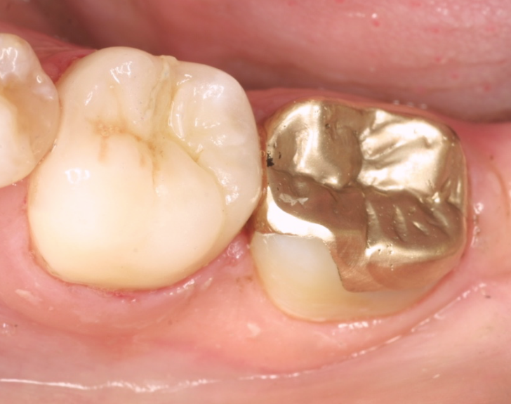 Neat strong crowns on back teeth