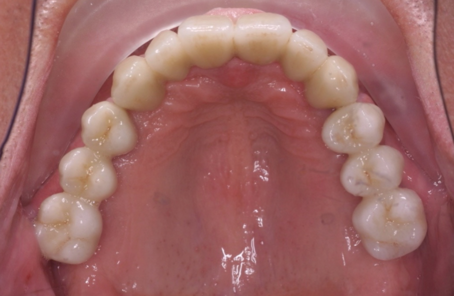 Full upper bridge on dental implants